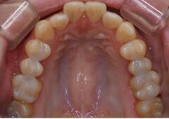 メタル2_コピー