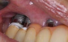 インプラント周囲炎_コピー