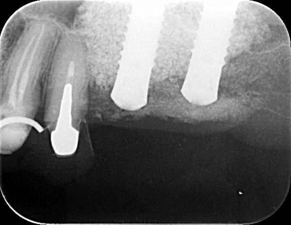 サイナスリフト 埋入後_コピー