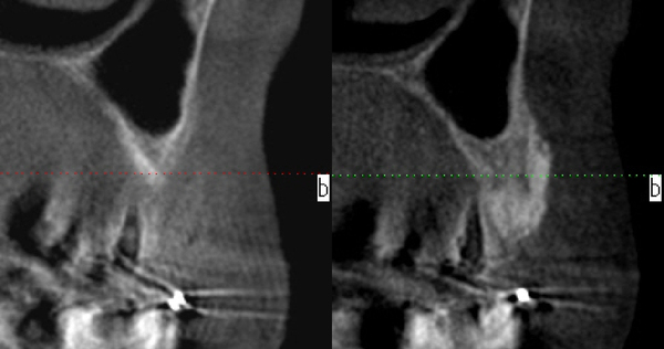 骨造成1_コピー